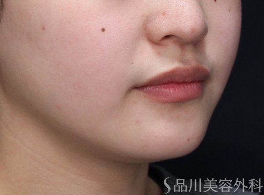症例NO.73871のBEFORE写真