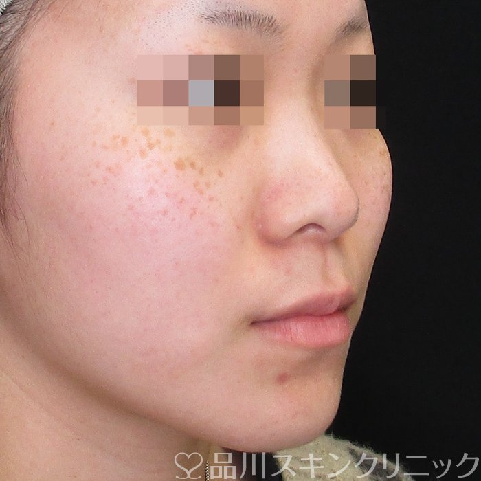 症例NO.73566のBEFORE写真