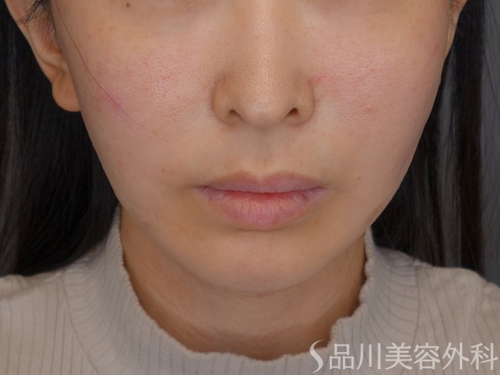 症例NO.74151のAFTER写真