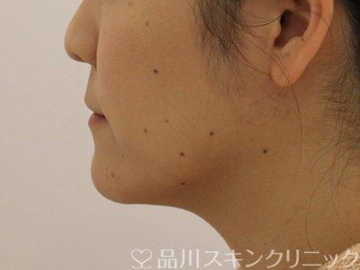 症例NO.71946のAFTER写真