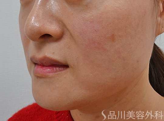 症例NO.73698のBEFORE写真