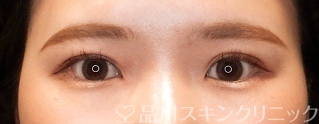 症例NO.70028のAFTER写真