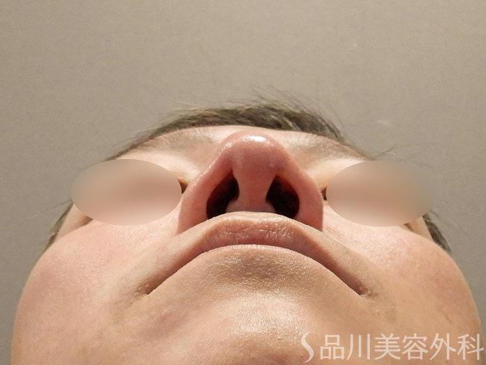 症例NO.70476のAFTER写真