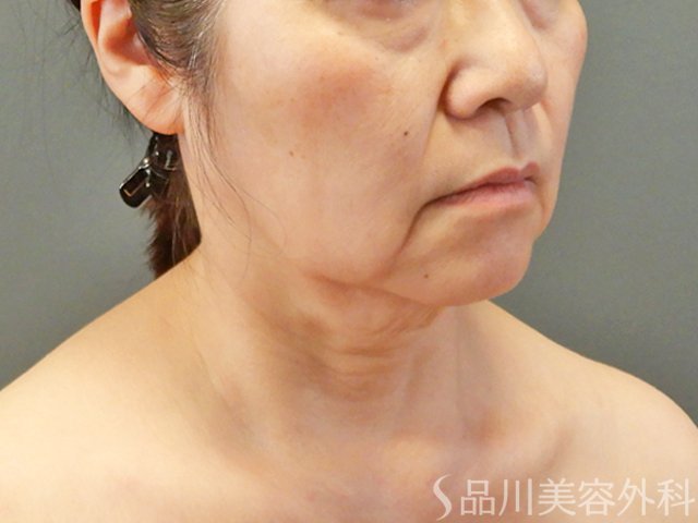 症例NO.67754のBEFORE写真