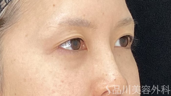 症例NO.71147のBEFORE写真