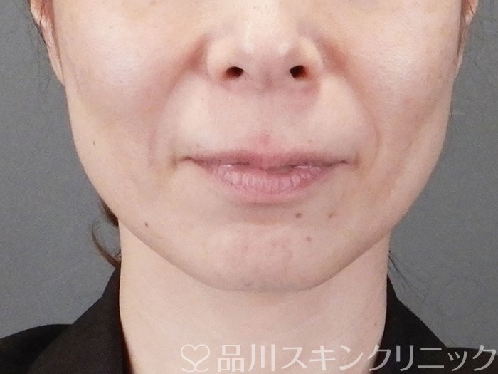 症例NO.75271のBEFORE写真