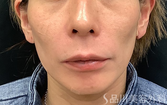 症例NO.69485のBEFORE写真