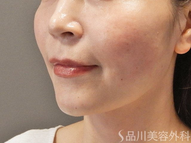 症例NO.74037のAFTER写真