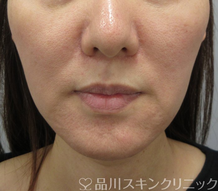 症例NO.75149のBEFORE写真