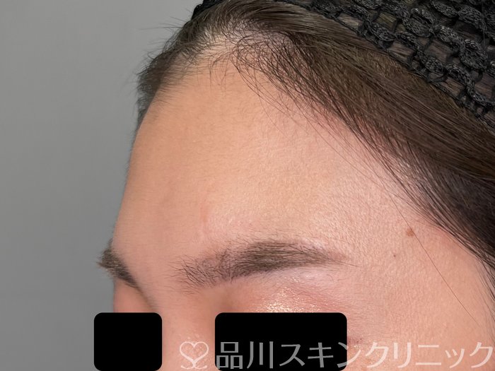 症例NO.69717のBEFORE写真