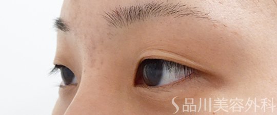 症例NO.62274のBEFORE写真