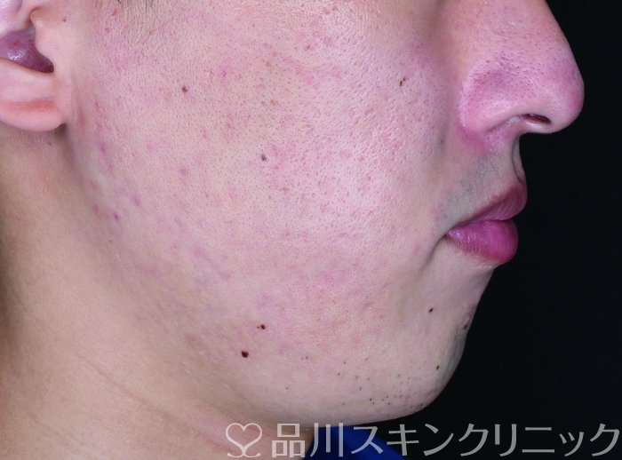 症例NO.65071のAFTER写真