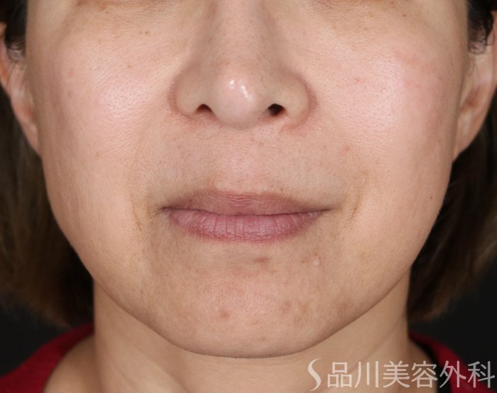 症例NO.74043のBEFORE写真
