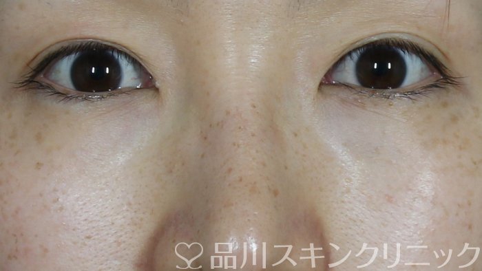 症例NO.71452のBEFORE写真