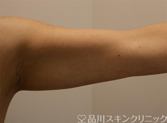 症例NO.46843のBEFORE写真