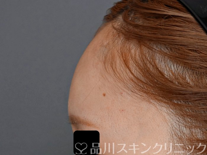 症例NO.71891のAFTER写真