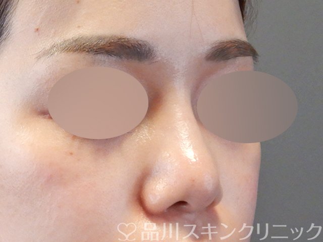 症例NO.67385のAFTER写真