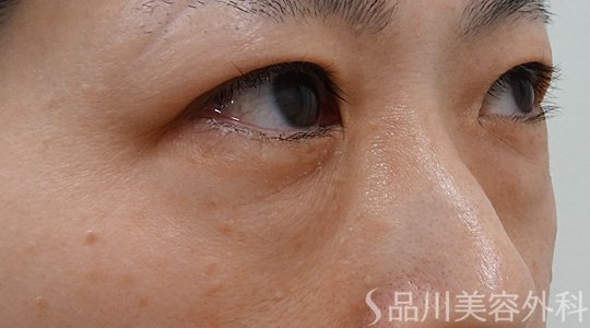 症例NO.73438のBEFORE写真