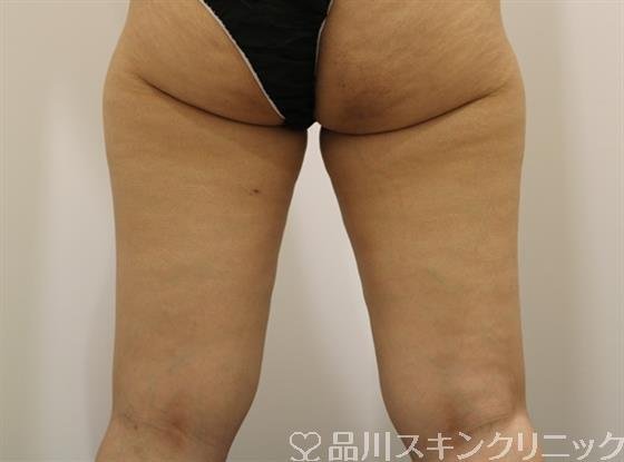 症例NO.44694のBEFORE写真
