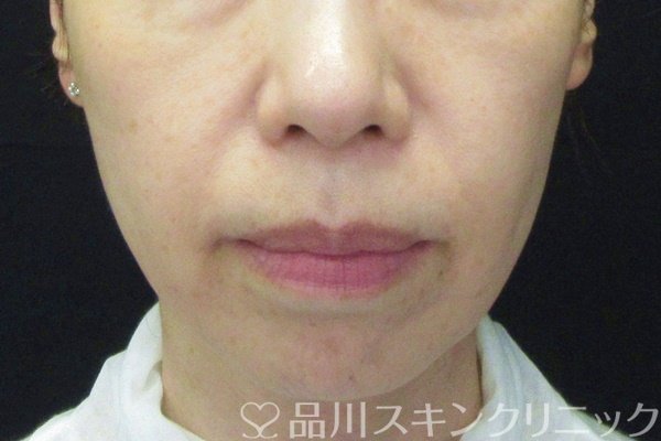 症例NO.64917のAFTER写真