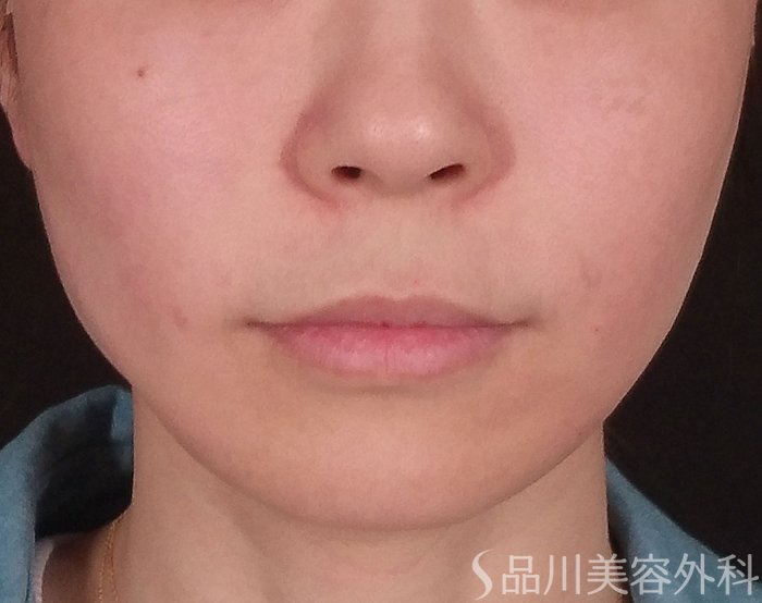 症例NO.70331のAFTER写真