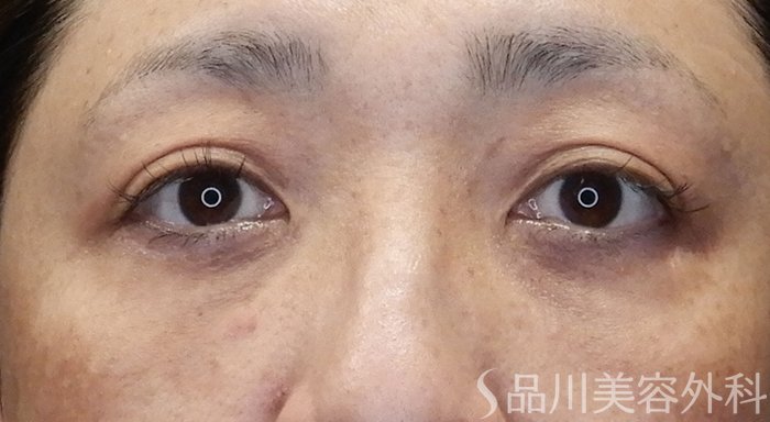 症例NO.70095のAFTER写真