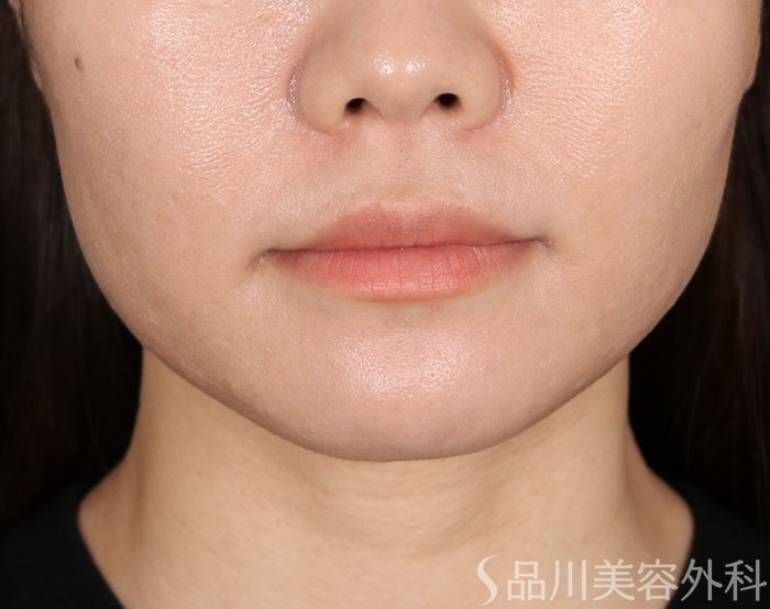 症例NO.71281のBEFORE写真