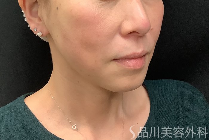 症例NO.71293のAFTER写真