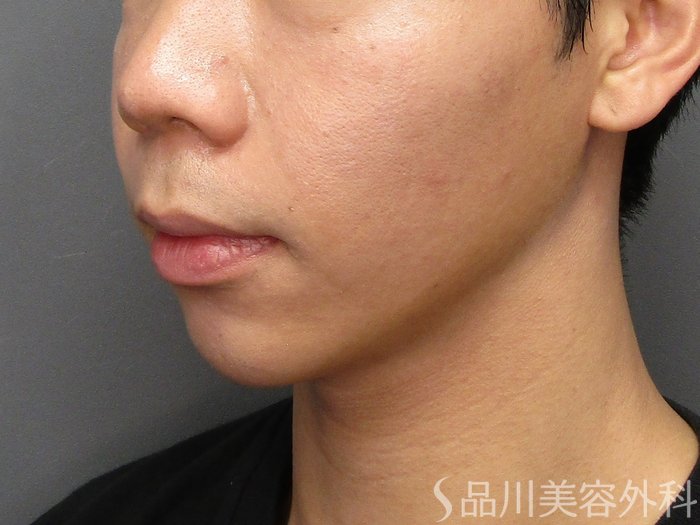 症例NO.74994のAFTER写真