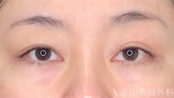 症例NO.60949のBEFORE写真