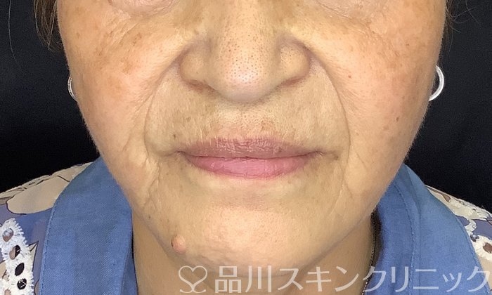 症例NO.75388のAFTER写真