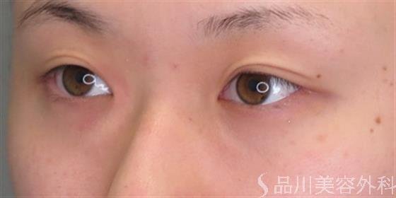 症例NO.48842のBEFORE写真