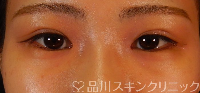 症例NO.66516のBEFORE写真