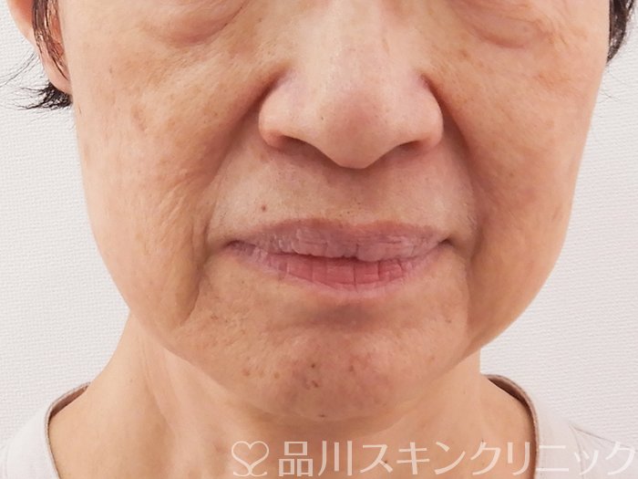 症例NO.62649のBEFORE写真