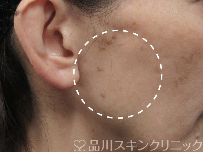 症例NO.69037のBEFORE写真