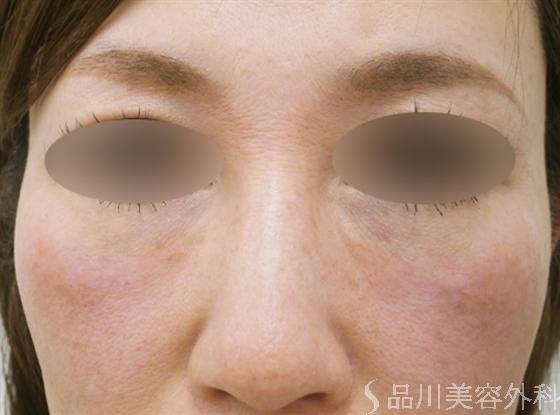 症例NO.15313のAFTER写真