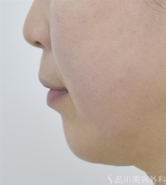 症例NO.51474のBEFORE写真