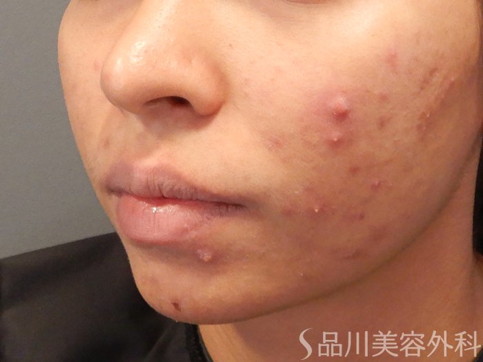症例NO.70713のBEFORE写真