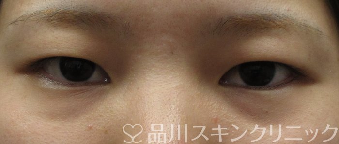 症例NO.62050のBEFORE写真