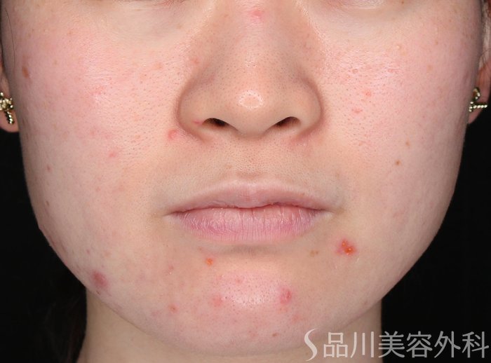 症例NO.72438のBEFORE写真