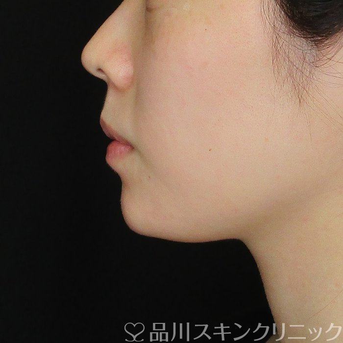 症例NO.74438のAFTER写真