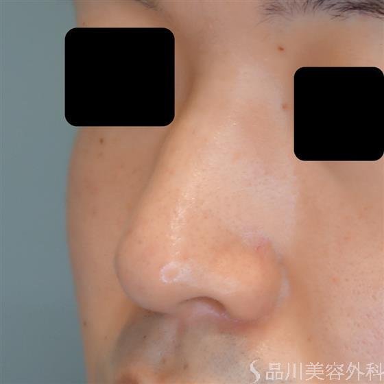 症例NO.53702のBEFORE写真
