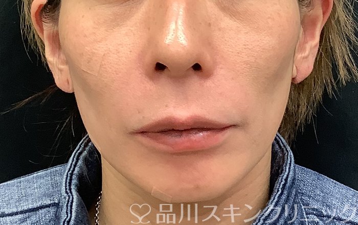 症例NO.69485のBEFORE写真
