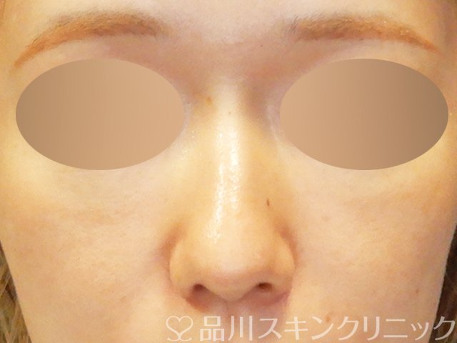 症例NO.67901のBEFORE写真