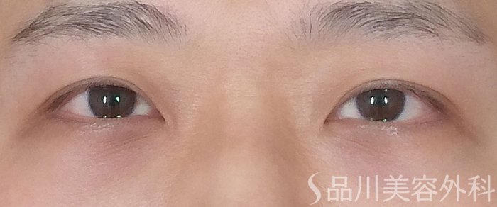 症例NO.71840のAFTER写真