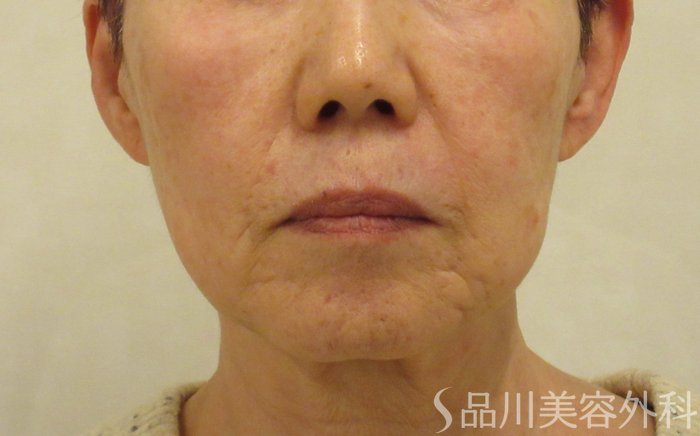 症例NO.73408のBEFORE写真