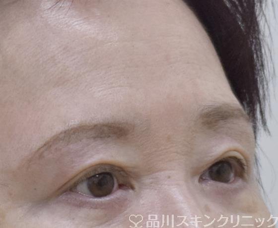 症例NO.59200のAFTER写真