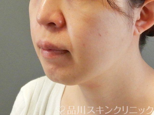 症例NO.63176のBEFORE写真