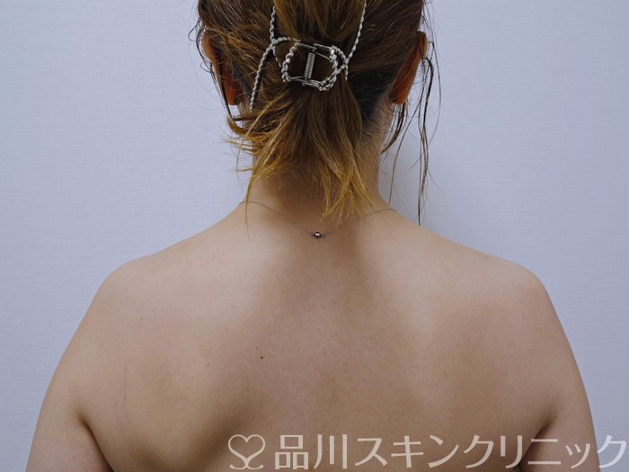 症例NO.74656のBEFORE写真