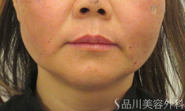 症例NO.73232のAFTER写真